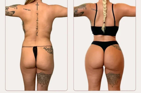 BRAZILIAN BUTT LIFT (BBL)