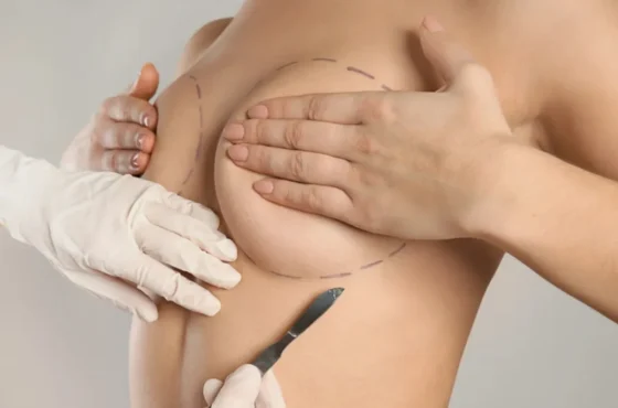 BREAST AUGMENTATION